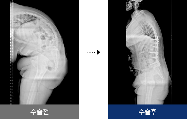 강직성척추염 수술 전 후