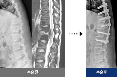 척추 감염 수술 전 후