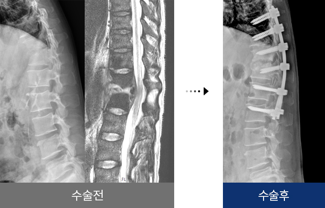 척추 감염 수술 전 후