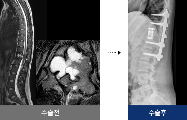 척추 종양 수술 전 후