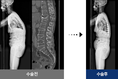 골다공증성 척추 골절 수술 전 후