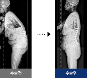척추 재수술 이전 수술 부위가 잘못된 경우 수술 전 후