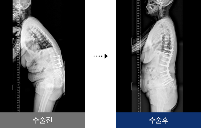 척추 재수술 이전 수술 부위가 잘못된 경우 수술 전 후
